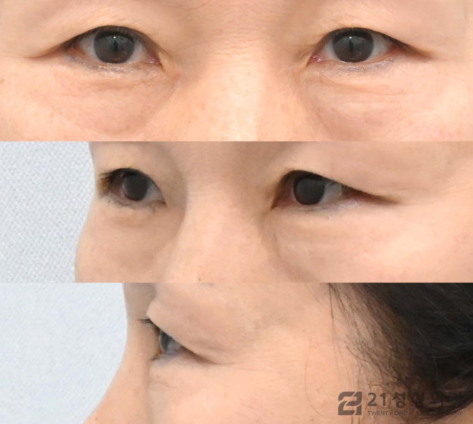하안검수술잘하는병원 선택 노하우는 관련 이미지 5