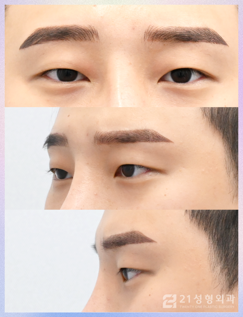 남자눈성형외과 결정에서 가장 중요한 핵심은 관련 이미지 6