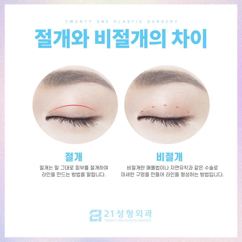 절개쌍꺼풀을 통한 자연스러운 라인 관련 이미지 3