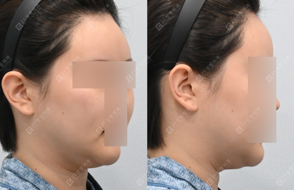 이중턱 지방흡입 받았는데 왜 그대로일까요? 관련 이미지 3