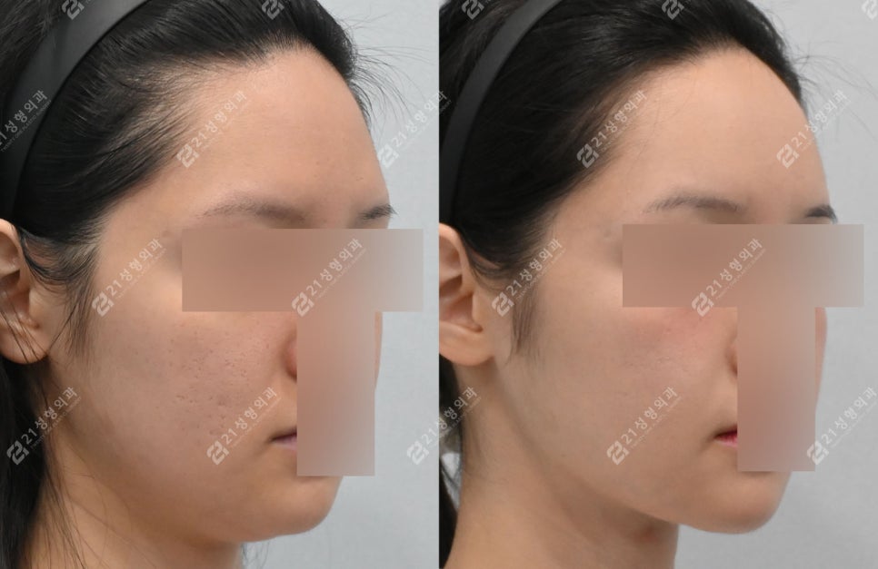 Double Chin Surgery, There Was Actually Another Cause (Real Case Analysis) image 7