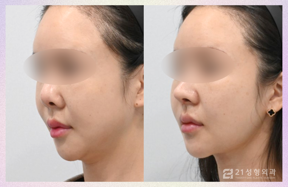 코성형잘하는곳 전체적인 비율을 고려해야 관련 이미지 4