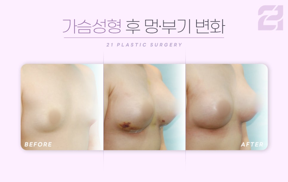 유방확대술 후 피주머니 착용 관련 이미지 7