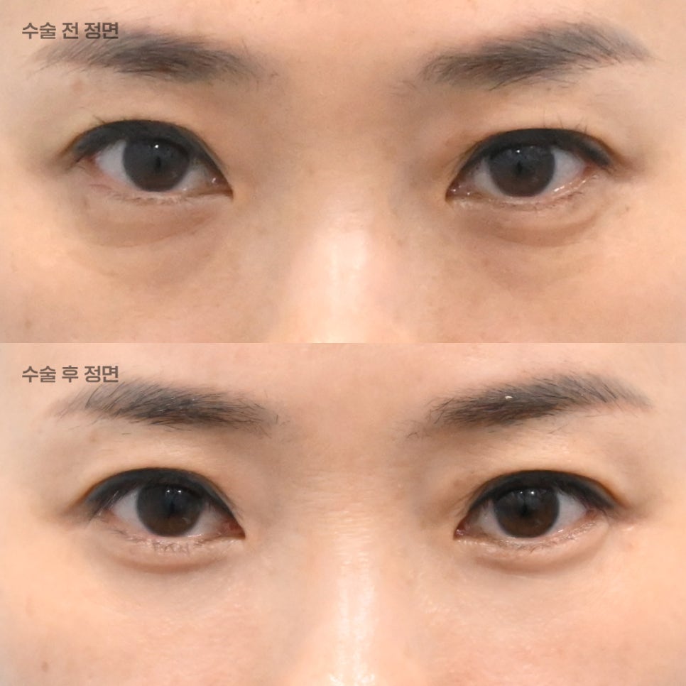 상담할 때 눈밑 피부를 먼저 확인하는 이유 관련 이미지 1