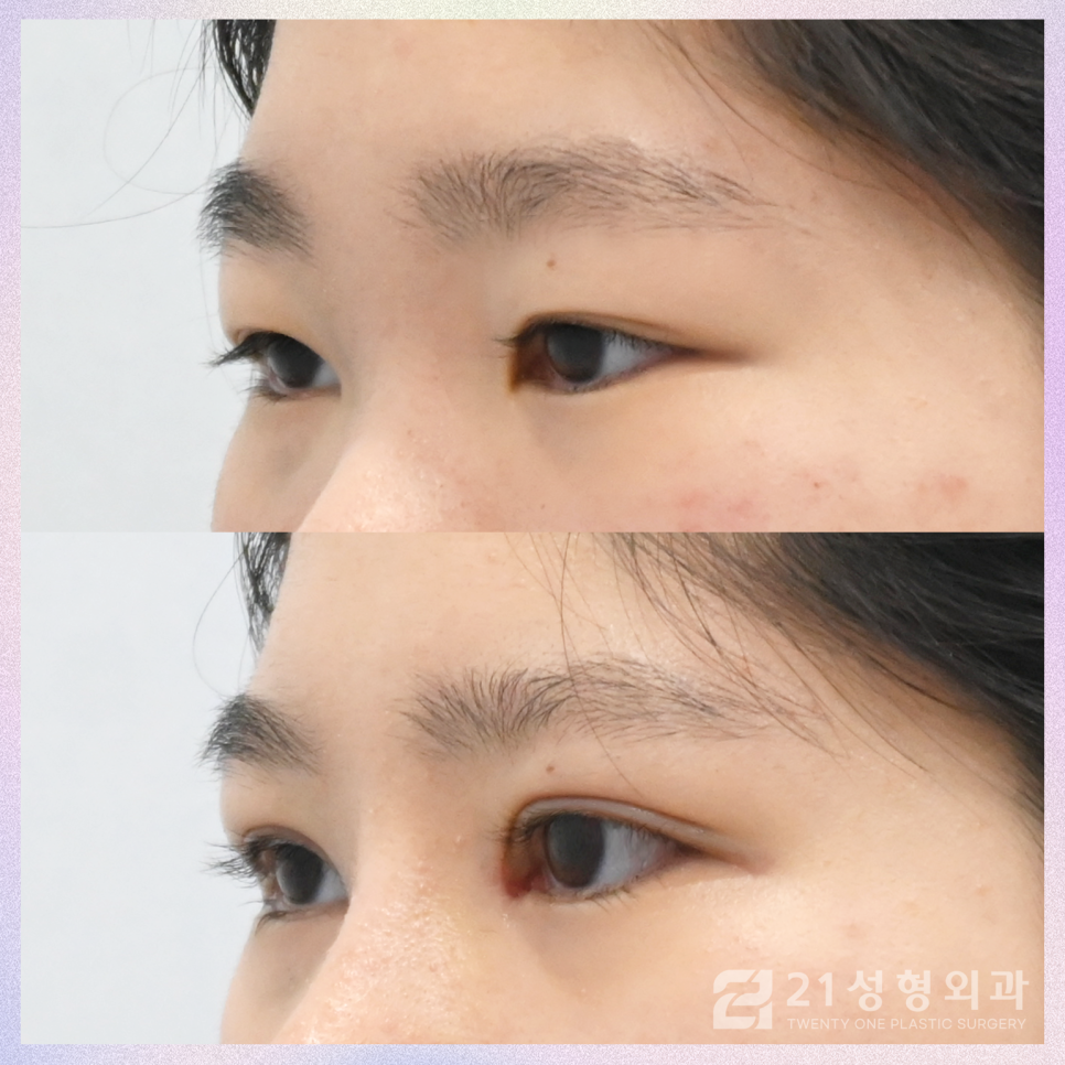 강남눈성형잘하는곳 차이점은 관련 이미지 2