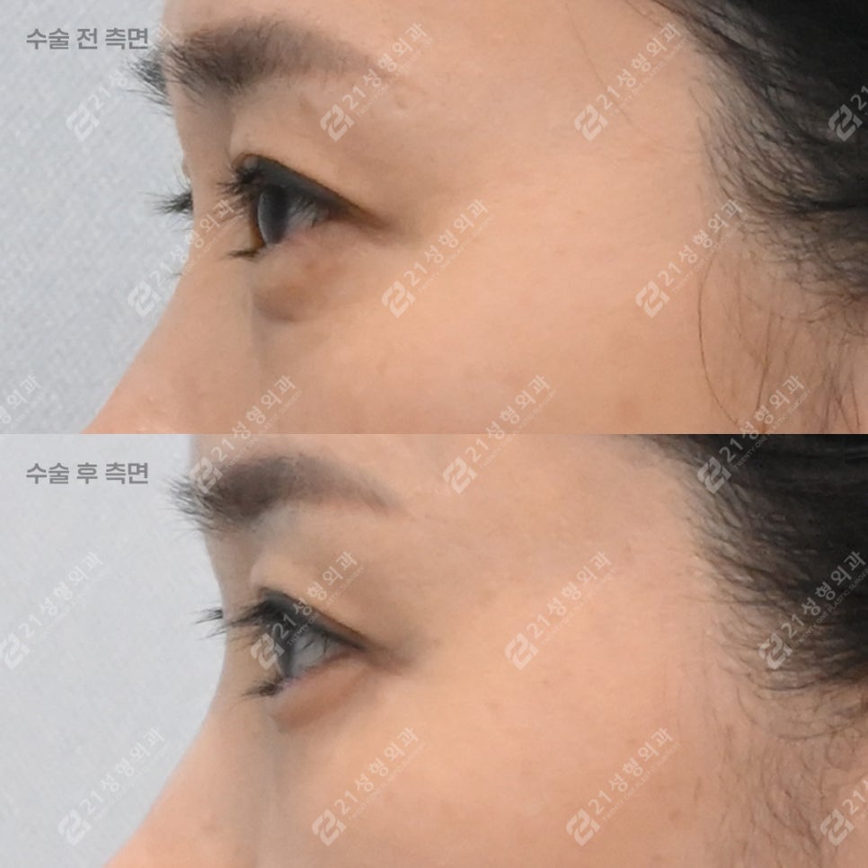 상담할 때 눈밑 피부를 먼저 확인하는 이유 관련 이미지 3
