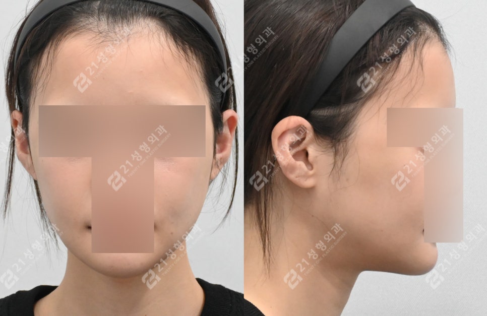 얼굴살이 적으면 윤곽수술 효과가 더 좋을까요? 관련 이미지 5