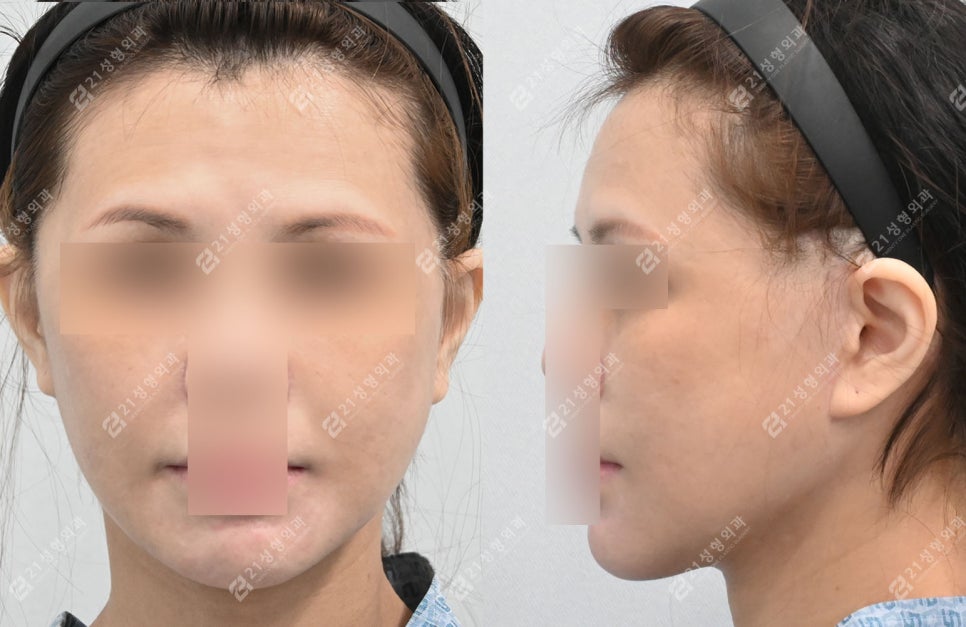 Face and Neck Lift: What Matters More Than Scars Is the Surgical Design image 4