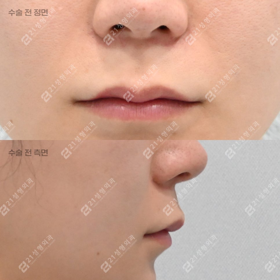 What to Check If Your Philtrum Looks Long image 3