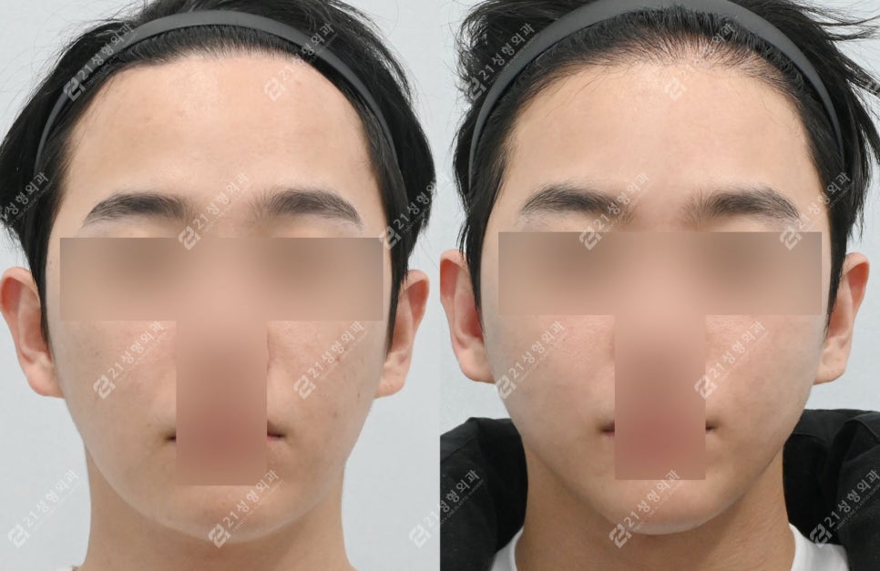 살은 안 쪘는데 왜 이중턱만 남을까? 남자 이중턱의 진짜 원인 관련 이미지 5
