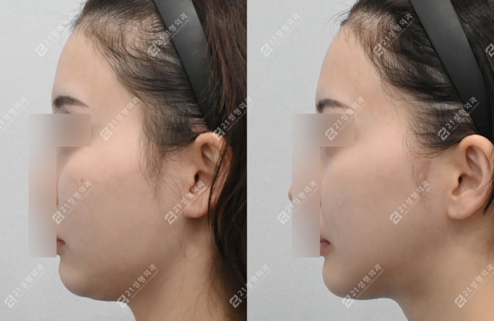 작은 얼굴이지만 윤곽 3종이 필요한 케이스: 턱끝 전진형 얼굴 분석 관련 이미지 7
