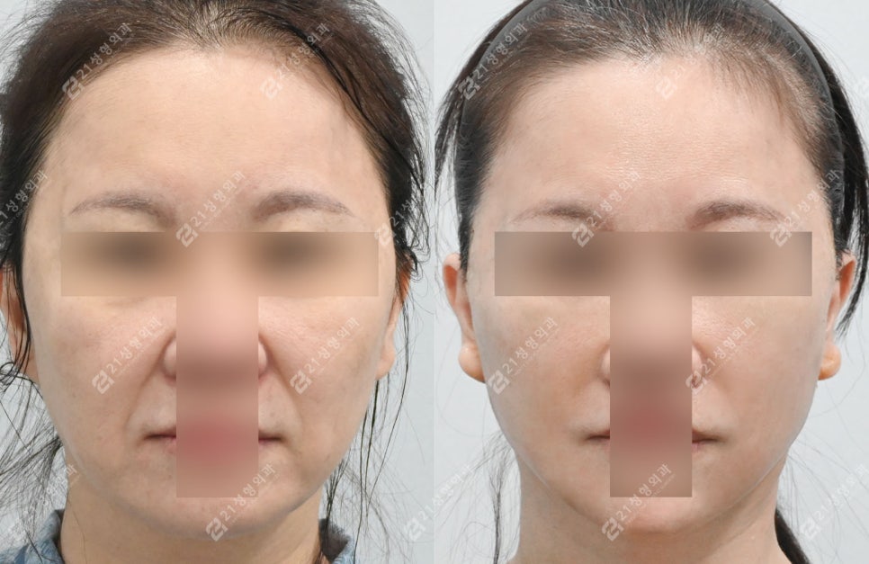 21성형외과에 사연을 들려주세요 두번째 이야기(안면거상/이중턱) 관련 이미지 2