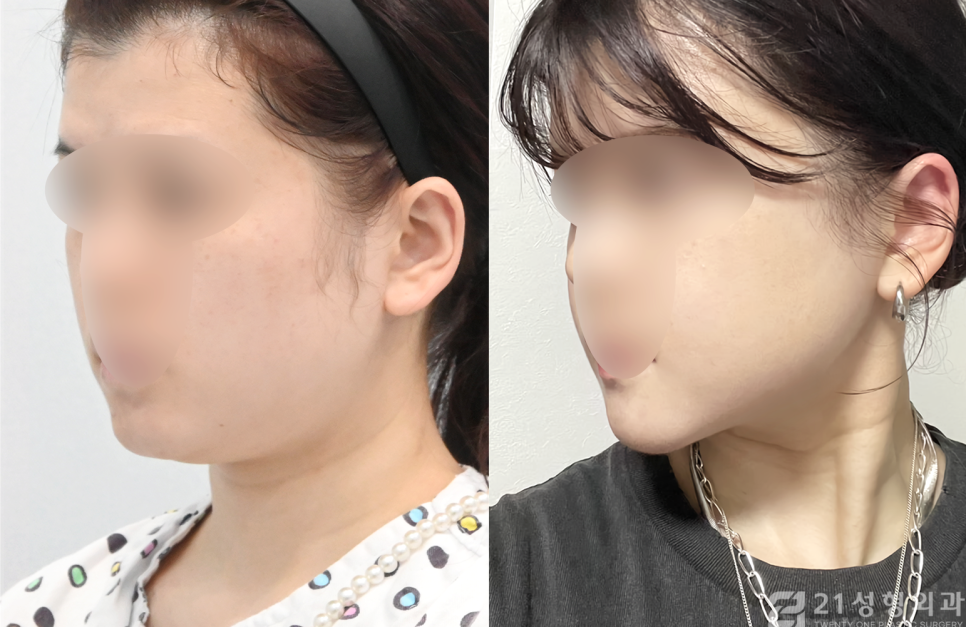 안면윤곽 3종 케이스에 따라 다른 수술과정 관련 이미지 2