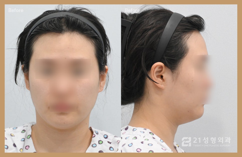 이중턱지방흡입부기 과정이 궁금하다면 관련 이미지 3