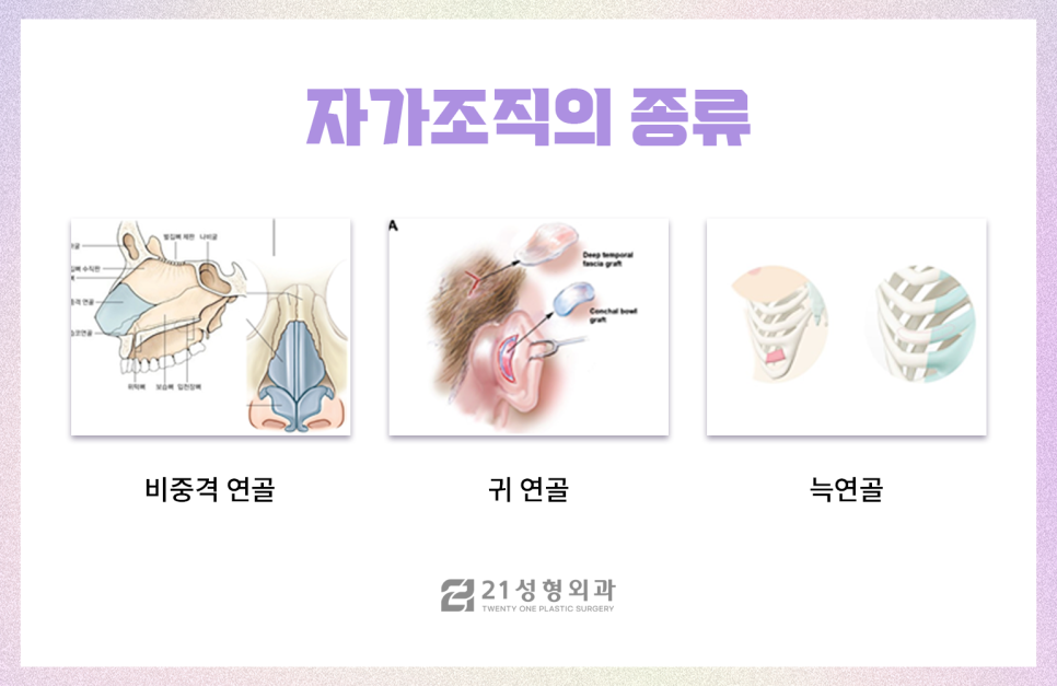 자가늑연골코성형 안전히고 아름다운 코 성형 관련 이미지 2