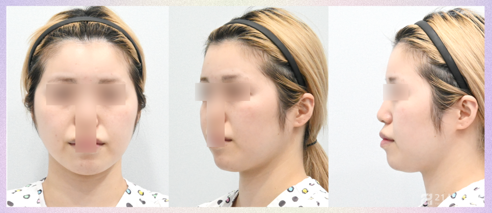 얼굴지방이식잘하는곳 노하우가 궁금하다면 관련 이미지 4