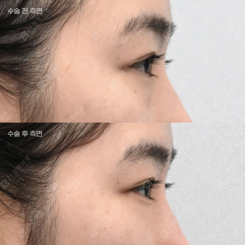 눈밑지애교 vs 하안검애교, 내게 맞는 눈밑수술은? 관련 이미지 6