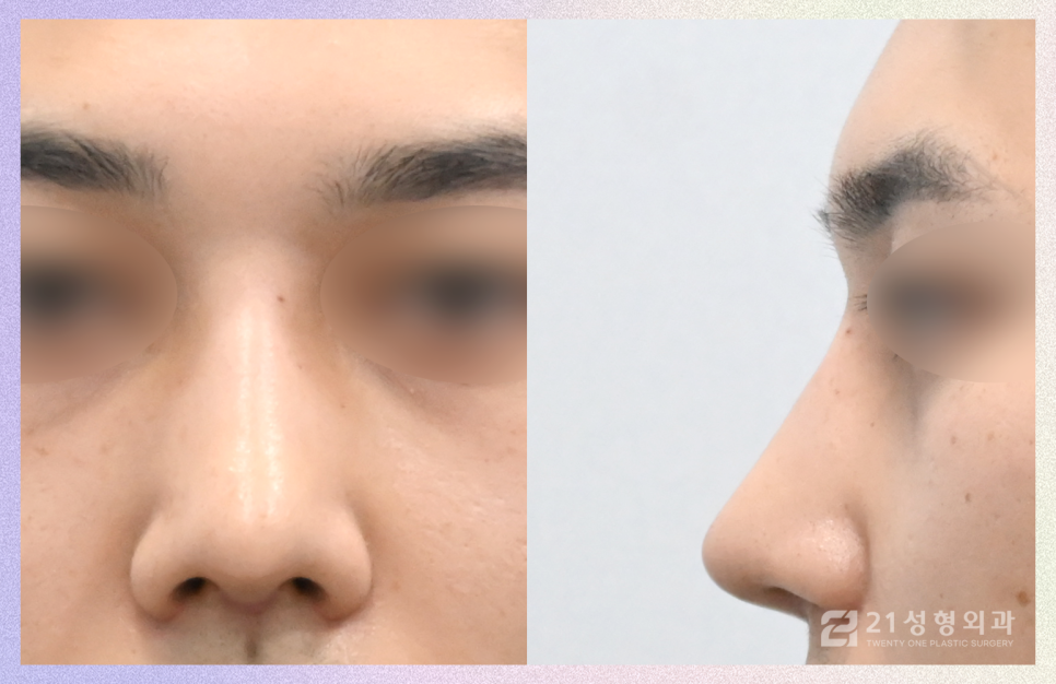 강남남자코수술 잘하는 병원의 기준 관련 이미지 5