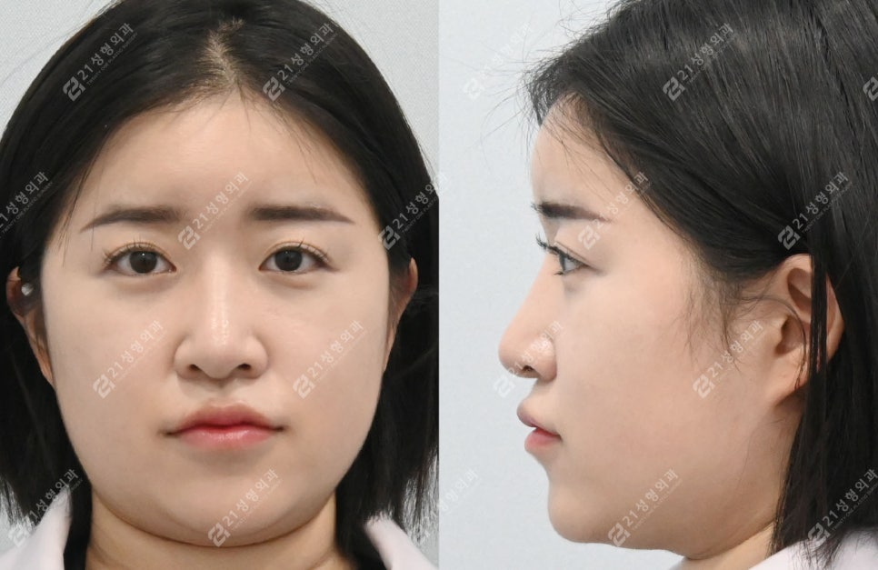 코성형 후 인상이 달라진 이유, 얼굴 중심의 차이 관련 이미지 1