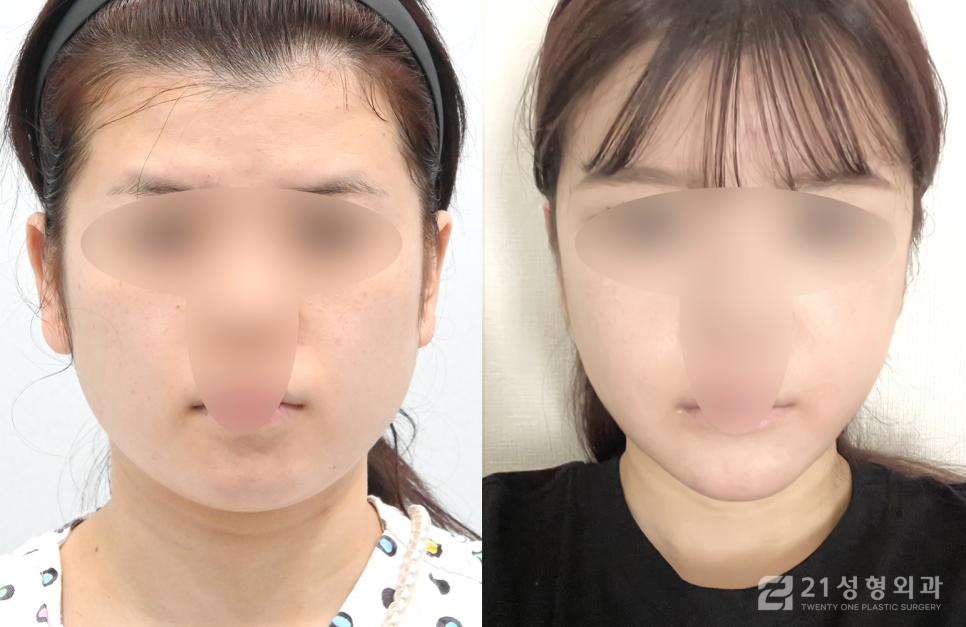 안면윤곽 3종 케이스에 따라 다른 수술과정 관련 이미지 1