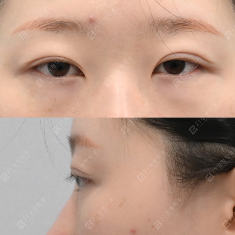 Recovery Period Before and After Lower Eyelid Fat Repositioning image 2