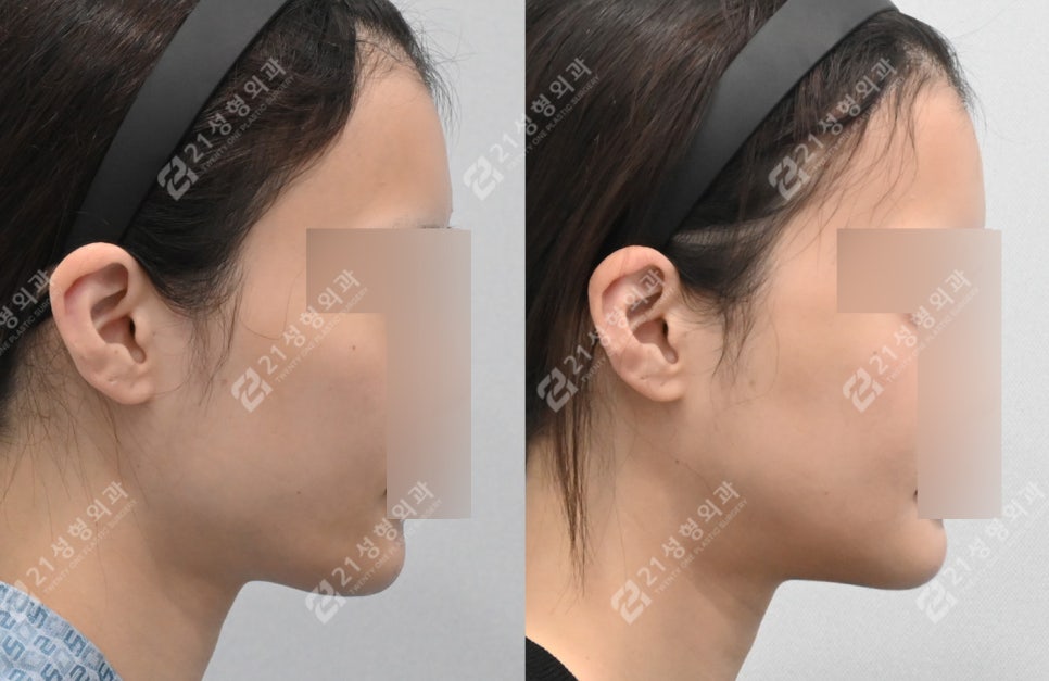 얼굴살이 적으면 윤곽수술 효과가 더 좋을까요? 관련 이미지 3
