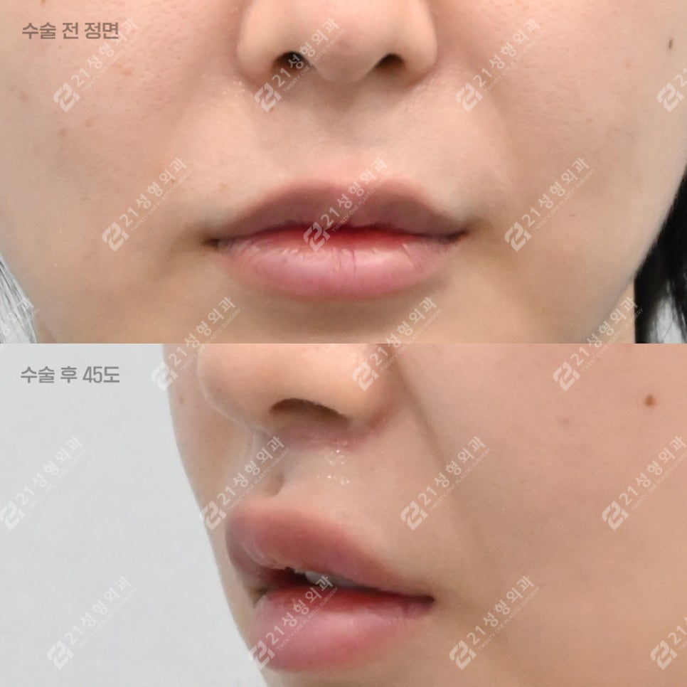 How to Make the Philtrum Look Shorter by Adding Dimension Alongside Philtrum Reduction Surgery image 5