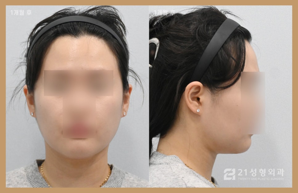이중턱지방흡입부기 과정이 궁금하다면 관련 이미지 5