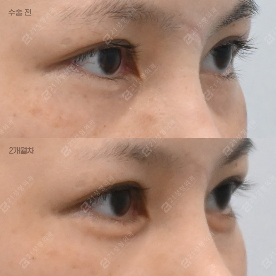 눈밑지방, 무조건 빼면 안 되는 이유 &ndash; 21성형외과 관련 이미지 5