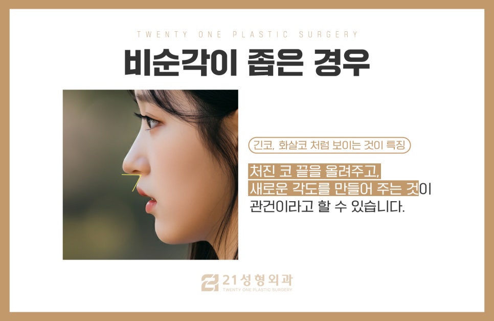 비순각교정만으로로 양악 효과 만들 수 있습니다 관련 이미지 5