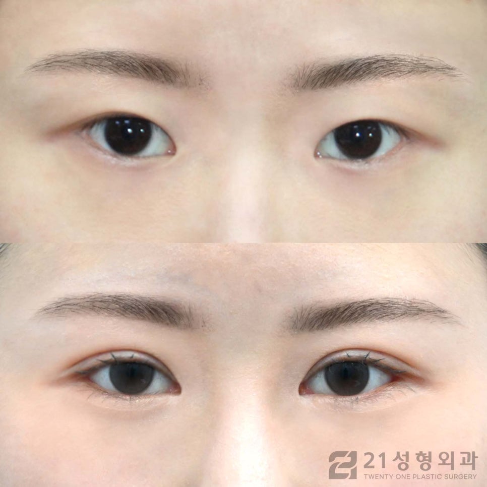 절개쌍수 특징적인 점에 대하여 관련 이미지 1