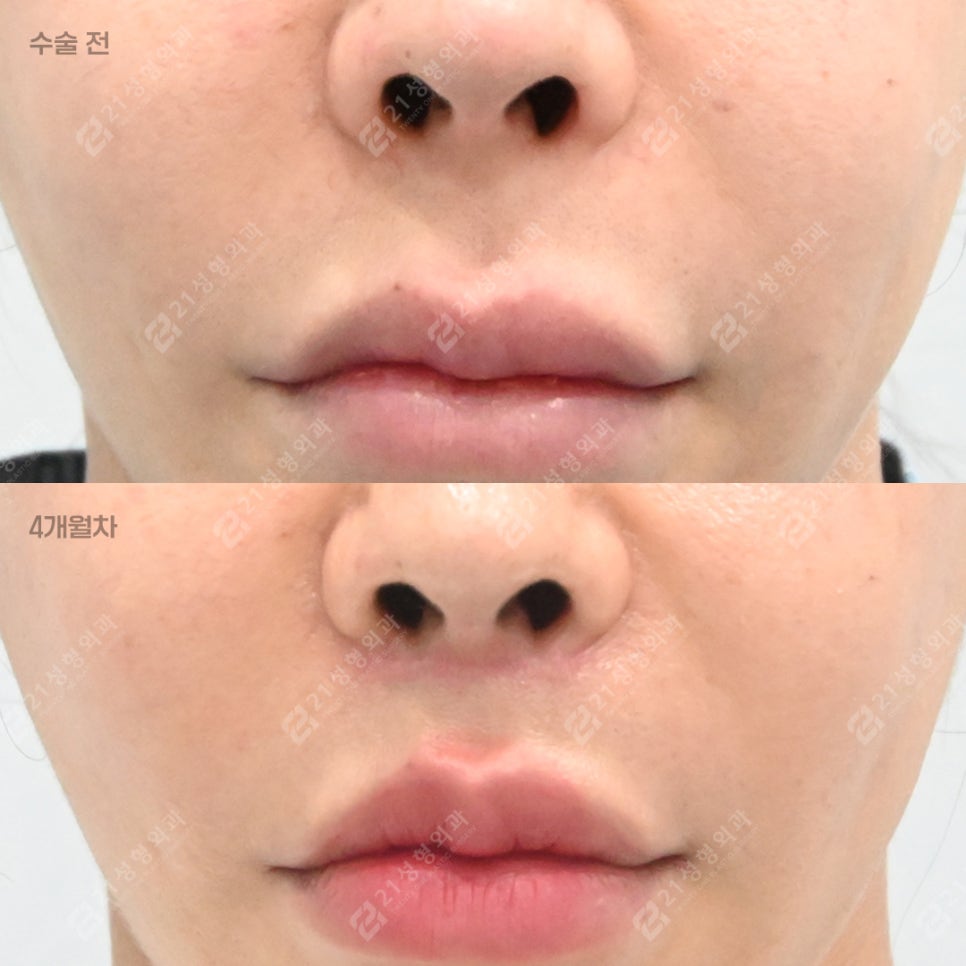 Why More People Are Seeking Philtrum Reduction Recently &ndash; 21성형외과 image 1
