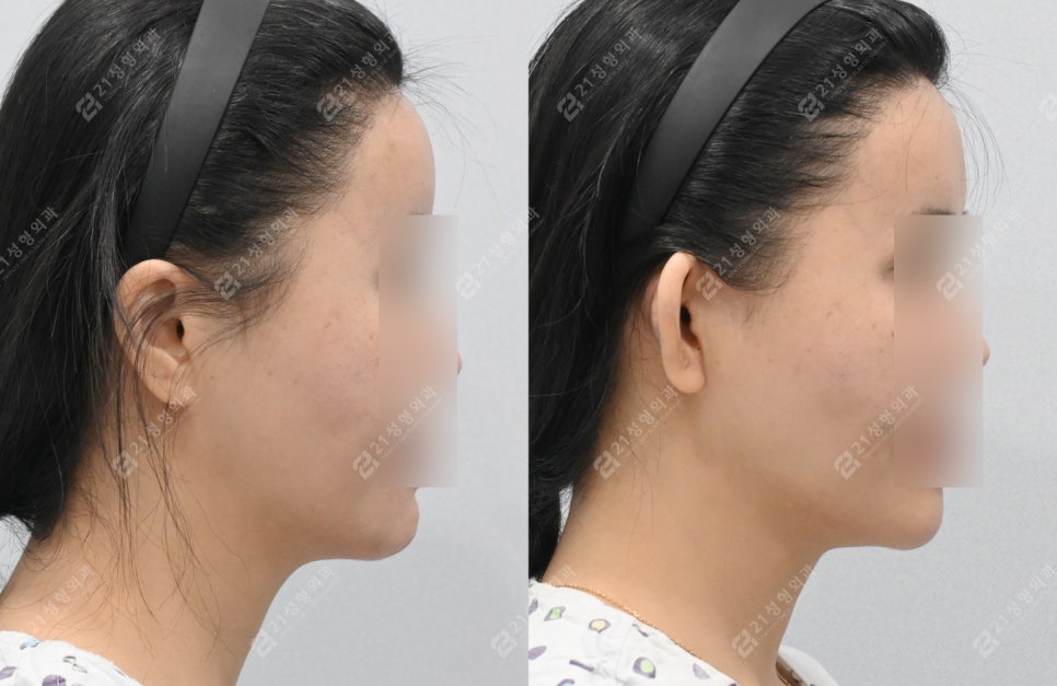 Fae Ear Filler Progress Before and After 3 Months image 3