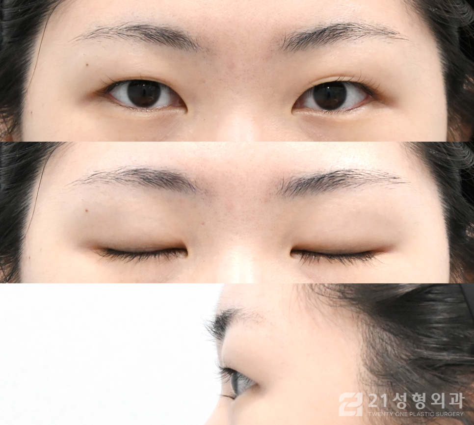 부분절개쌍꺼풀 아름다운 눈매를 위해 관련 이미지 5