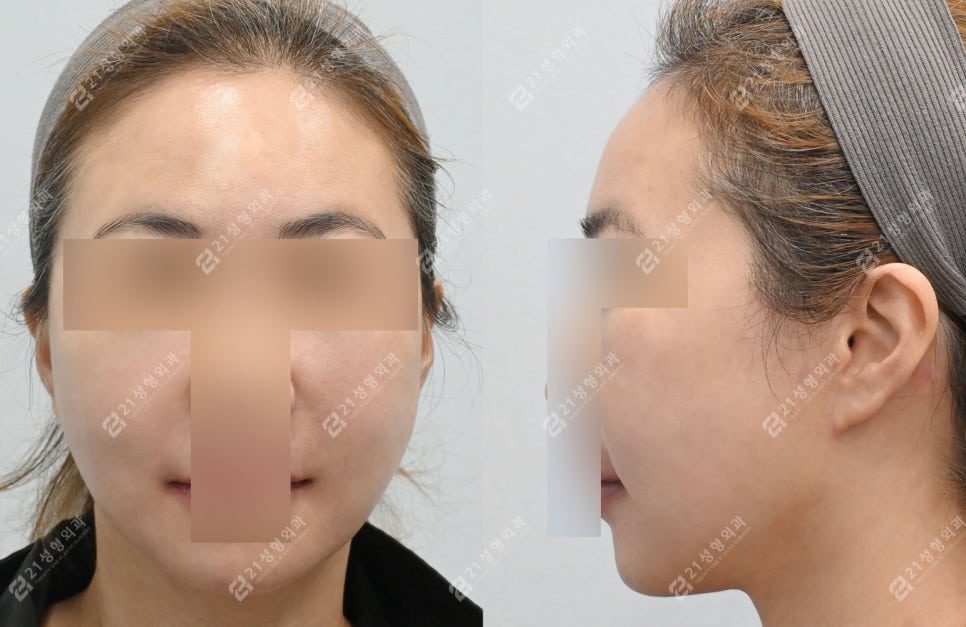 Facial and Neck Lift: The Key Is Structure, Not Skin | Real Before-and-After Review image 5