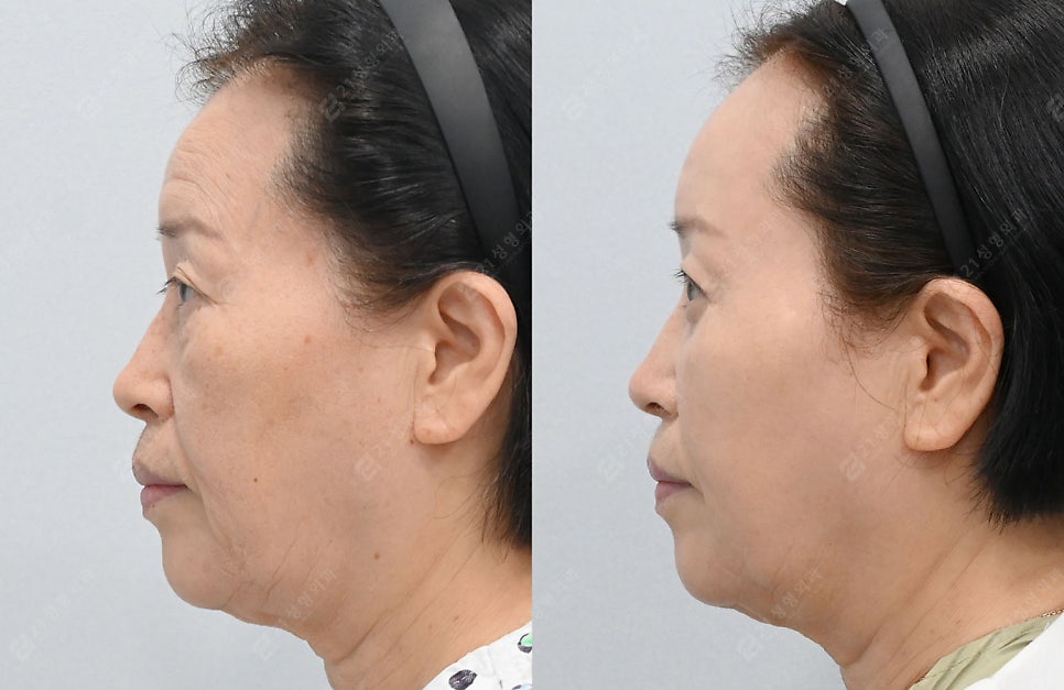 자연스럽게 젊어지고 싶다면? 중년 수술 이마거상, 상.하안검으로 해결! 관련 이미지 6