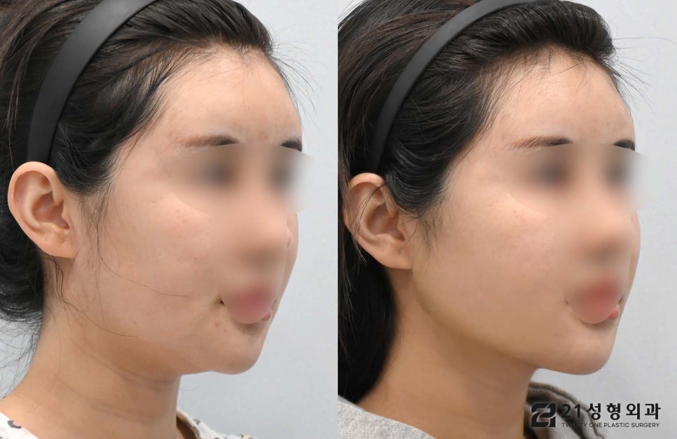 투턱없애기 이중턱근육묶기로 해결 관련 이미지 2