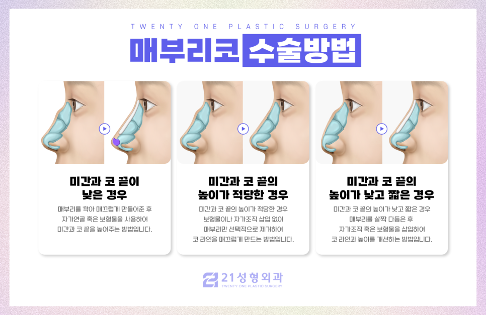 매부리코성형 나에게 맞는 교정 방법 관련 이미지 4