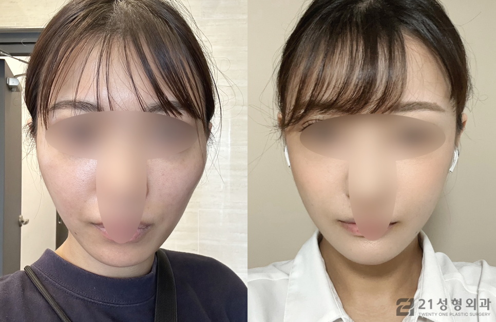 옆광대수술 세련된 이미지로 아름답게 관련 이미지 1