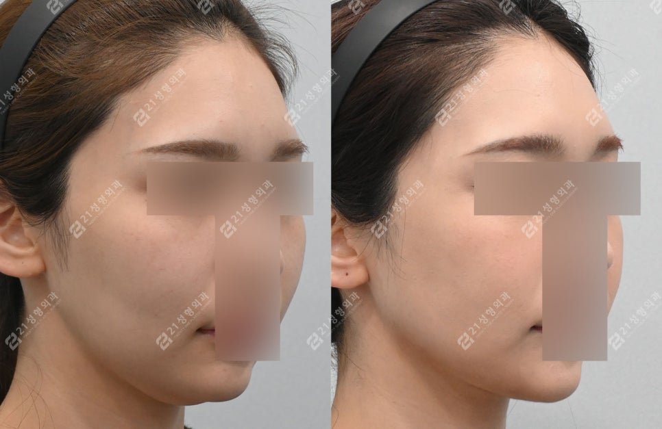 Before and After Cheekbone Reduction: Changes in Facial Width (4 Months · 1 Year) image 7