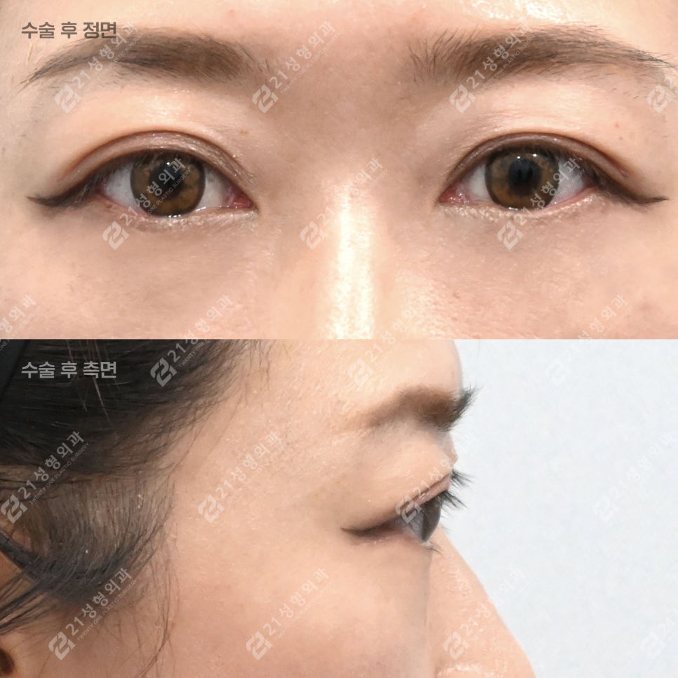 If People Always Tell You That You Look Tired, Could Under-Eye Fat Be the Cause? image 2