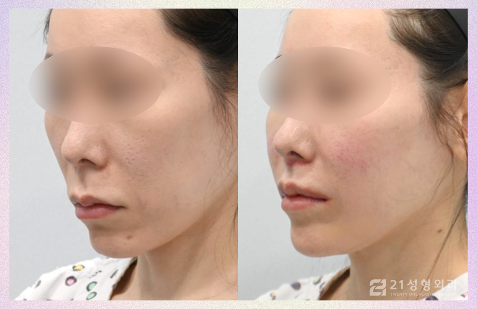 강남인중성형만으로 중안부 줄이기 관련 이미지 2