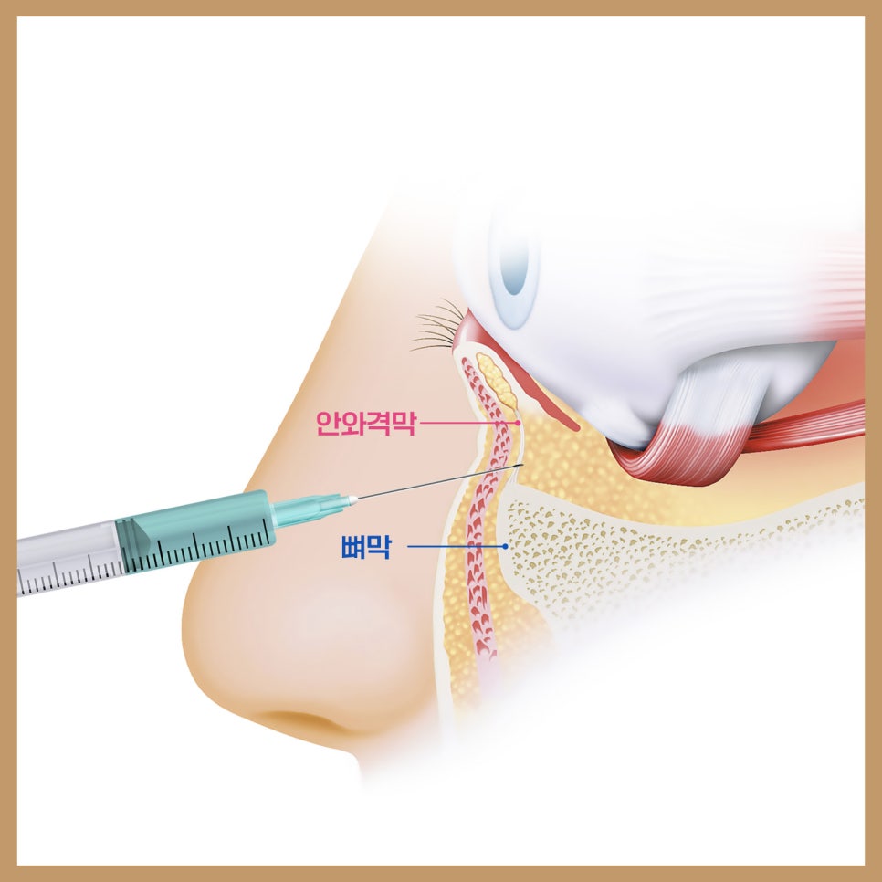 눈밑애교필러 대신 장원영 애교 만드는 쉬운 방법 관련 이미지 5