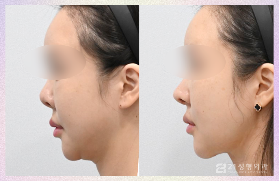 코성형잘하는곳 전체적인 비율을 고려해야 관련 이미지 5