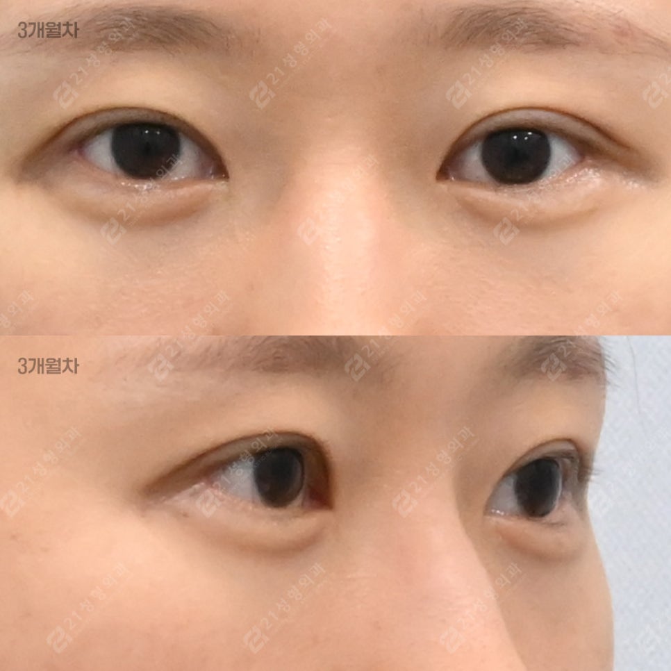 With Lower-Eyelid Fat Repositioning and Fat Grafting: The Real Reason Your Eyes Look Different image 6