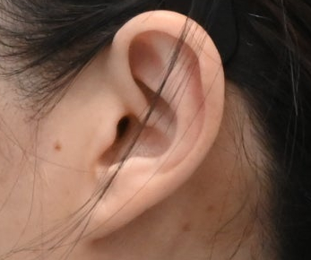Natural Ear Lines Without Knife-Edge Earlobes: Facelift + Neck Lift Surgery Review image 2