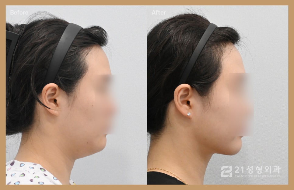 이중턱지방흡입부기 과정이 궁금하다면 관련 이미지 1