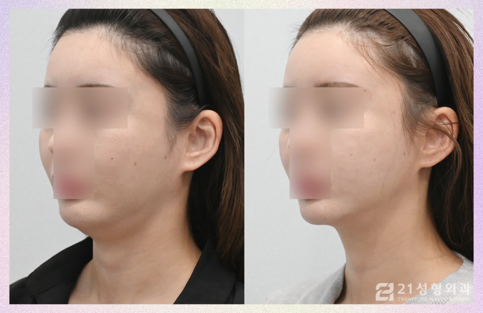 이중턱재수술은 근육묶기로 완성하자 관련 이미지 2