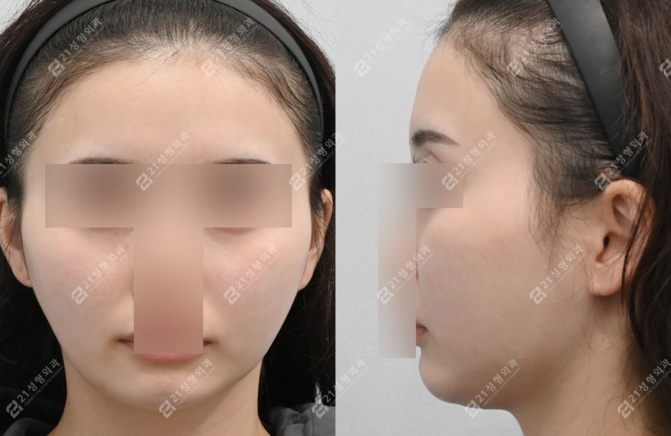 작은 얼굴이지만 윤곽 3종이 필요한 케이스: 턱끝 전진형 얼굴 분석 관련 이미지 2