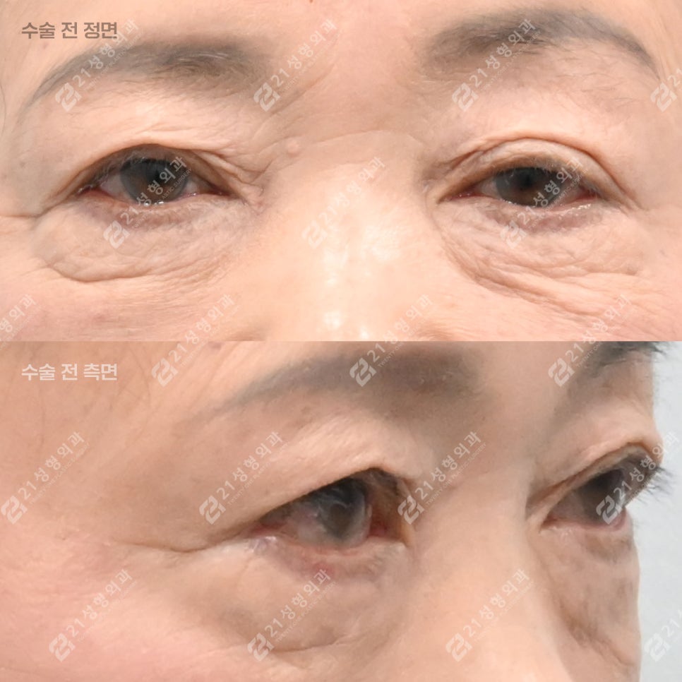 이거 모르면 하안검 수술 절대 하지 마세요! 관련 이미지 2